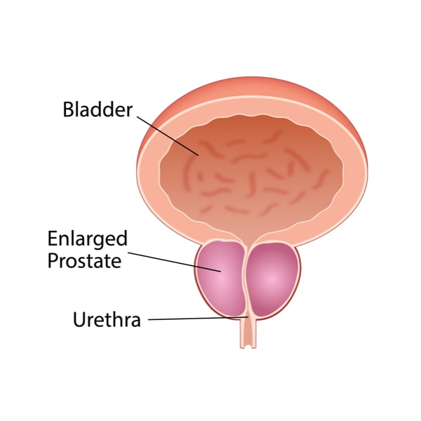 Benign prostatic hyperplasia, or BPH, is the medical term used to describe an enlarged prostate.