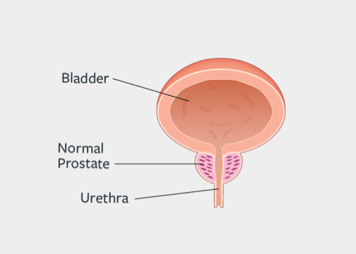 Bladder Irritants: Common Culprits, and How to Manage Them