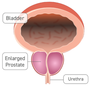 A diagram of the bladder, urethra, and an enlarged prostate.